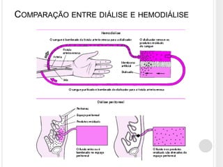 COMPARAÇÃO ENTRE DIÁLISE E HEMODIÁLISE
 