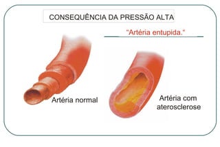 CONSEQUÊNCIA DA PRESSÃO ALTA

“Artéria entupida.“

Artéria normal

Artéria com
aterosclerose

 