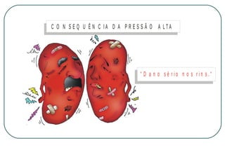 C O N S E Q U Ê N C IA D A P R E S S Ã O A LTA

“ D a n o sé r io n o s rin s.“

M IN IS T É R IO D A S A Ú D E
C o o r d e n a ç ã o d e D o e n ç a s C r ô n ic o - D e g e n e r a t iv a s

 