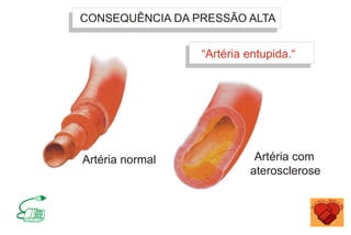 CONSEQUÊNCIA DA PRESSÃO ALTA
Artéria normal
“Artéria entupida.“
Artéria com
aterosclerose
 