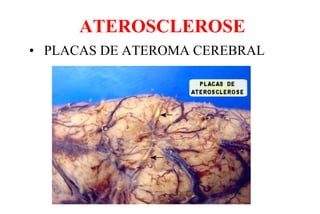 ATEROSCLEROSE
• PLACAS DE ATEROMA CEREBRAL
 