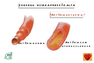 C O N S E Q U N C IA D A P R E S S Ã O AL T A


                          “Ar t é r ia e n t u p id a .“




Ar t é r ia n o r m a l              Ar t é r ia c o m
                                    atero s clero s e
 