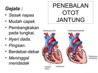 PENEBALAN
OTOT
JANTUNG
Gejala :
• Sesak napas
• Mudah capek
• Pembengkakan
pada tungkai.
• Nyeri dada.
• Pingsan.
• Berdebar-debar
• Meninggal
mendadak
 