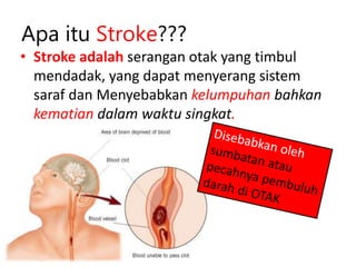 • Stroke adalah serangan otak yang timbul
mendadak, yang dapat menyerang sistem
saraf dan Menyebabkan kelumpuhan bahkan
kematian dalam waktu singkat.
Apa itu Stroke???
 