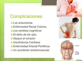 Complicaciones
 Los aneurismas
 Enfermedad Renal Crónica
 Los cambios cognitivos
 El daño de los ojos
 Ataque al corazón
 Insuficiencia Cardíaca
 Enfermedad Arterial Periférica
 Un accidente cerebrovascular
 