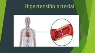 Hipertensión arterial
 