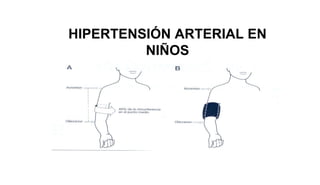 HIPERTENSIÓN ARTERIAL EN
NIÑOS
 