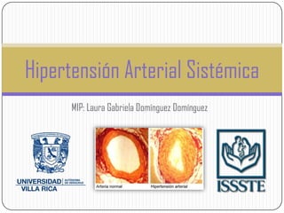MIP: Laura Gabriela Domínguez Domínguez
Hipertensión Arterial Sistémica
 