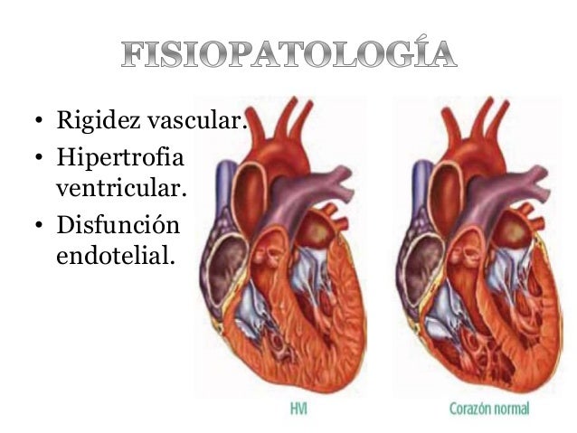Hipertensión arterial sistémica
