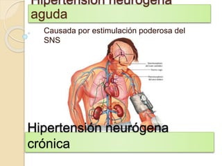 Hipertensión neurógena
crónica
Causada por estimulación poderosa del
SNS
Hipertensión neurógena
aguda
 
