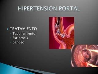 TRATAMIENTOTaponamientoEsclerosisbandeoHIPERTENSIÓN PORTAL