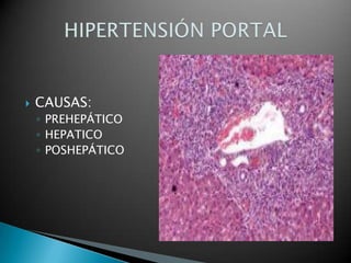CAUSAS:PREHEPÁTICOHEPATICOPOSHEPÁTICOHIPERTENSIÓN PORTAL