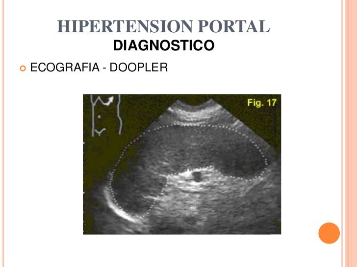 hipertensión pulmonar en el recien nacido Consejos y Guía