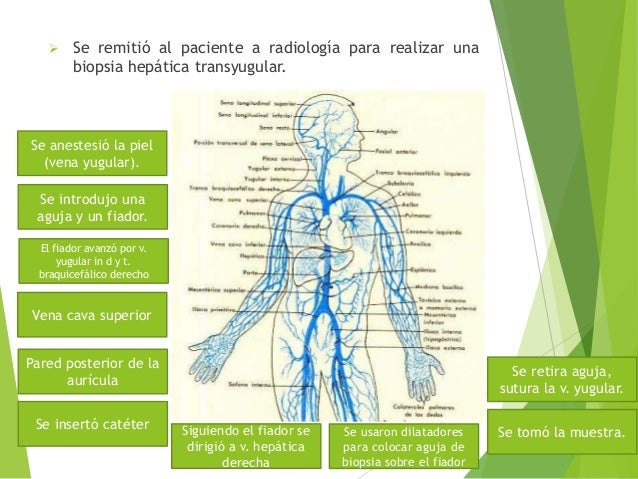 cadena iliaca primitiva derecha hipertensi 243 n portal cadena iliaca primitiva derecha hipertensi 243 n portal