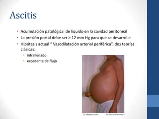 Ascitis
 • Acumulación patológica de líquido en la cavidad peritoneal
 • La presión portal debe ser ≥ 12 mm Hg para que se desarrolle
 • Hipótesis actual “ Vasodilatación arterial periférica”, dos teorías
   clásicas:
    • infrallenado
    • excedente de flujo
 
