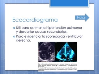 ÍNDICE
Ecocardiograma
 Útil
     para estimar la hipertensión pulmonar
  y descartar causas secundarias.
 Para evidenciar la sobrecarga ventricular
  derecha.
 