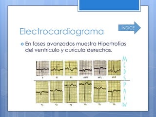 ÍNDICE
Electrocardiograma
 En
   fases avanzadas muestra Hipertrofias
 del ventrículo y aurícula derechas.
 