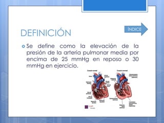 ÍNDICE
DEFINICIÓN
 Se define como la elevación de la
 presión de la arteria pulmonar media por
 encima de 25 mmHg en reposo o 30
 mmHg en ejercicio.
 