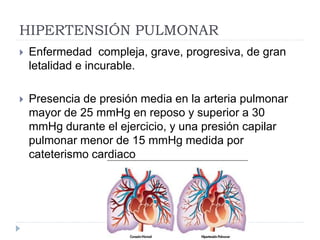 HIPERTENSIÓN PULMONAR
 Enfermedad compleja, grave, progresiva, de gran
letalidad e incurable.
 Presencia de presión media en la arteria pulmonar
mayor de 25 mmHg en reposo y superior a 30
mmHg durante el ejercicio, y una presión capilar
pulmonar menor de 15 mmHg medida por
cateterismo cardiaco
 