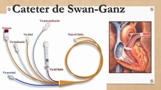Cateter de Swan-Ganz

 