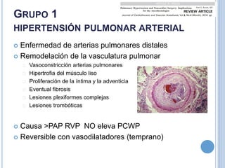 GRUPO 1
HIPERTENSIÓN PULMONAR ARTERIAL
 Enfermedad de arterias pulmonares distales
 Remodelación de la vasculatura pulmonar
Vasoconstricción arterias pulmonares
Hipertrofia del músculo liso
Proliferación de la íntima y la adventicia
Eventual fibrosis
Lesiones plexiformes complejas
Lesiones trombóticas
 Causa >PAP RVP NO eleva PCWP
 Reversible con vasodilatadores (temprano)
 