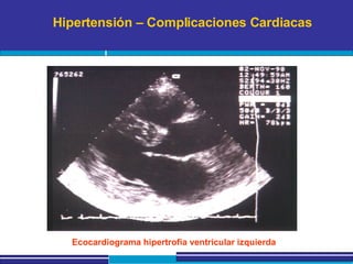 Hipertensión – Complicaciones Cardiacas Ecocardiograma hipertrofia ventricular izquierda 