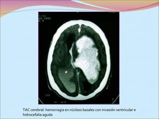 TAC cerebral: hemorragia en núcleos basales con invasión ventricular e hidrocefalia aguda 