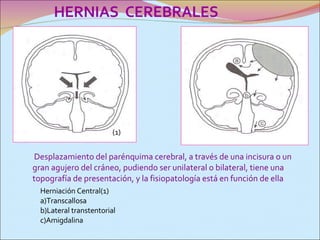 Desplazamiento del parénquima cerebral, a través de una incisura o un gran agujero del cráneo, pudiendo ser unilateral o bilateral, tiene una topografía de presentación, y la fisiopatología está en función de ella Herniación Central(1)       a)Transcallosa      b)Lateral transtentorial      c)Amigdalina HERNIAS  CEREBRALES   (1) 