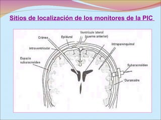 Sitios de localización de los monitores de la PIC  