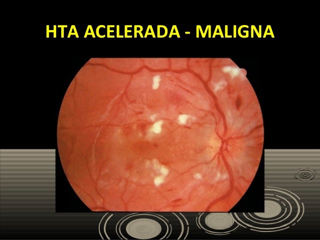 No hacer esto si causa de la hipertensión arterial