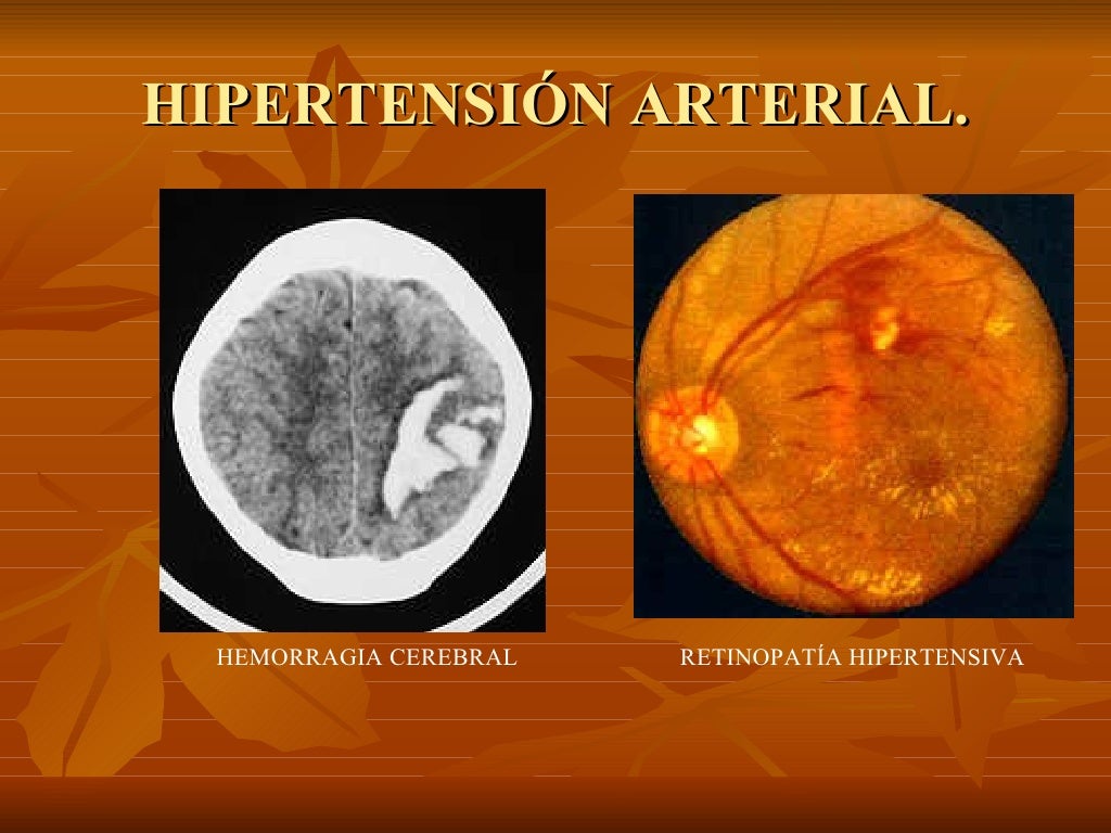 Maniquíes aproximadamente hipertensión pulmonar precapilar