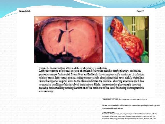 Tratamiento De La Hipertensin Intracraneal De Origen Tumoral Maligno