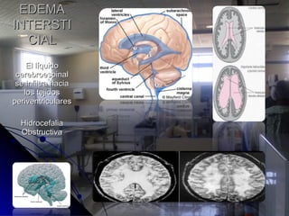 El líquidoEl líquido
cerebroespinalcerebroespinal
se infiltra haciase infiltra hacia
los tejidoslos tejidos
periventricularesperiventriculares
HidrocefaliaHidrocefalia
ObstructivaObstructiva
EDEMAEDEMA
INTERSTIINTERSTI
CIALCIAL
 