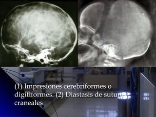 (1) Impresiones cerebriformes o
digitiformes. (2) Diastasis de suturas
craneales
 