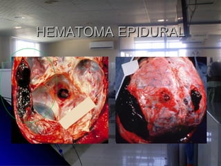 HEMATOMA EPIDURALHEMATOMA EPIDURAL
 