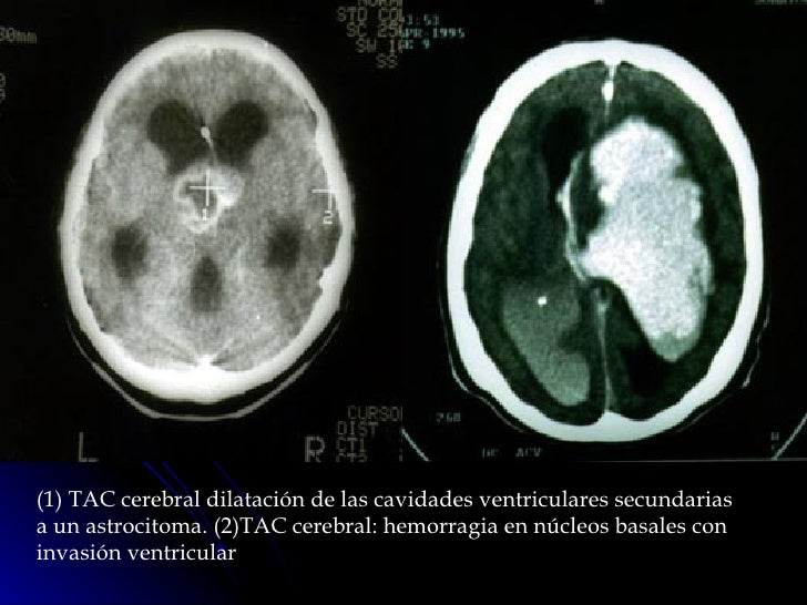Una palabra: clasificación hipertensión pulmonar