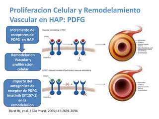 Proliferacion Celular y Remodelamiento
Vascular en HAP: PDFG
Incremento de
receptores de
PDFG en HAP
Remodelacion
Vascular y
proliferacion
celular
Impacto del
antagonista de
receptor de PDFG
Imatinib (ST157-1)
en la
remodelacion
Barst RJ, et al. J Clin Invest. 2005;115:2691-2694
 