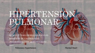 HIPERTENSION
PULMONAR
MARIA VICTORIA MORALES MORALES
ROTACIÓN DE CARDIOLOGIA
PRESENTADO A DR HERNAN CALVO
2023
 