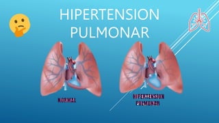 HIPERTENSION
PULMONAR
 