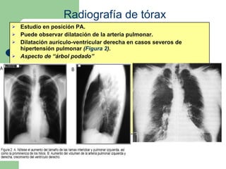 Radiografía de tórax Estudio en posición PA. Puede observar dilatación de la arteria pulmonar. Dilatación aurículo-ventricular derecha en casos severos de hipertensión pulmonar  ( Figura 2 ). Aspecto de “árbol podado”   