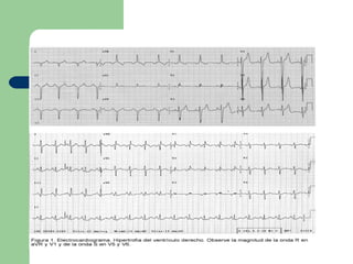 Electrocardiograma   