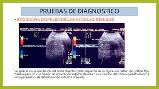 Se aprecia en la circulación del riñón derecho (parte izquierda de la figura) un patrón de gráfico tipo
"tardus-parvus" y un tiempo de aceleración sistólico elevado. La circulación del riñón izquierdo muestra
unos parámetros de determinación indirecta normales.
 