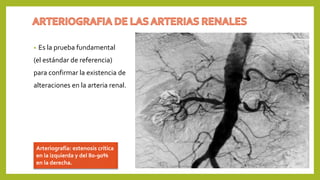 • Es la prueba fundamental
(el estándar de referencia)
para confirmar la existencia de
alteraciones en la arteria renal.
Arteriografía: estenosis crítica
en la izquierda y del 80-90%
en la derecha.
 