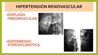HIPERTENSIÓN RENOVASCULAR
.
 