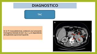 TAC
En la TC toracoabdominal, evidenció una tumoración
homogénea lobulada de 6,8 × 6,2 × 4 cm dependiente
de la glándula suprarrenal izquierda
 