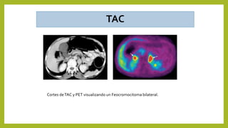 TAC
Cortes deTAC y PET visualizando un Feocromocitoma bilateral.
 