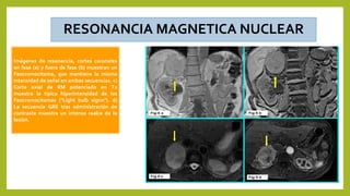 RESONANCIA MAGNETICA NUCLEAR
Imágenes de resonancia, cortes coronales
en fase (a) y fuera de fase (b) muestran un
Feocromocitoma, que mantiene la misma
intensidad de señal en ambas secuencias. c)
Corte axial de RM potenciado en T2
muestra la típica hiperintensidad de los
Feocromocitomas ("Light bulb signn"). d)
La secuencia GRE tras administración de
contraste muestra un intenso realce de la
lesión.
 