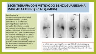 ESCINTIGRAFIA CON METILYODO BENZILGUANIDIANA
MARCADA CON I-131 o I-123 (MIBG)
se solicita rastreo gammagráfico con 123I-MIBG. El estudio a las 4 y 24
horas postinyección del radiofármaco muestra importante captación del
mismo, de morfología redondeada, en hemiabdomen izquierdo y de mayor
intensidad en el rastreo de las 24 horas .
La utilidad de la
metayodobencilguanidina (MIBG)
marcada con 123I o 131I está
demostrada en la detección
gammagráfica de los tumores
derivados del sistema nervioso
adrenérgico. es un análogo estructural
de la norepinefrina. Al ser administrada
se produce una captación selectiva por
las neuronas adrenérgicas y la médula
adrenal y se concentra en los gránulos
neurosecretores de las células
cromafines, pero con poca afinidad por
los receptores postsinápticos, con lo
que no se produce respuesta
farmacológica.
 