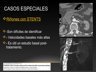 Stents Rinones Hipertension vasculo renal | PPT
