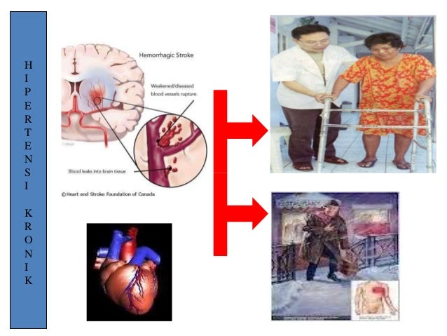 Hipertensi pada lansia